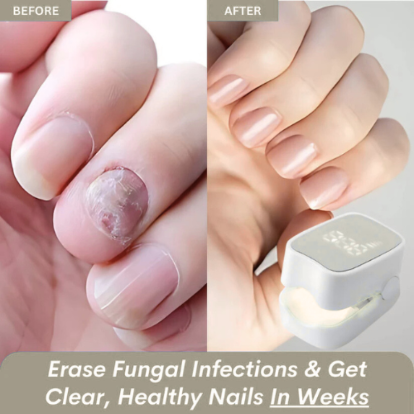 prime™ - Nail Fungus Laser Device