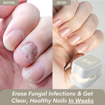 prime™ - Nail Fungus Laser Device