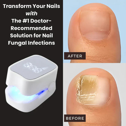 prime™ - Nail Fungus Laser Device